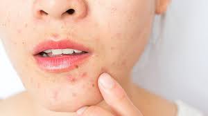 جوش های استرسی را چگونه کنترل کنیم